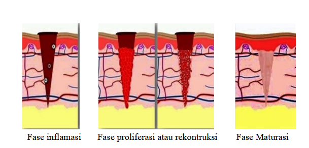 Terobosan Perawatan Luka Diabetes: Inovasi Modern Dressing dengan Kompres Metronidazole